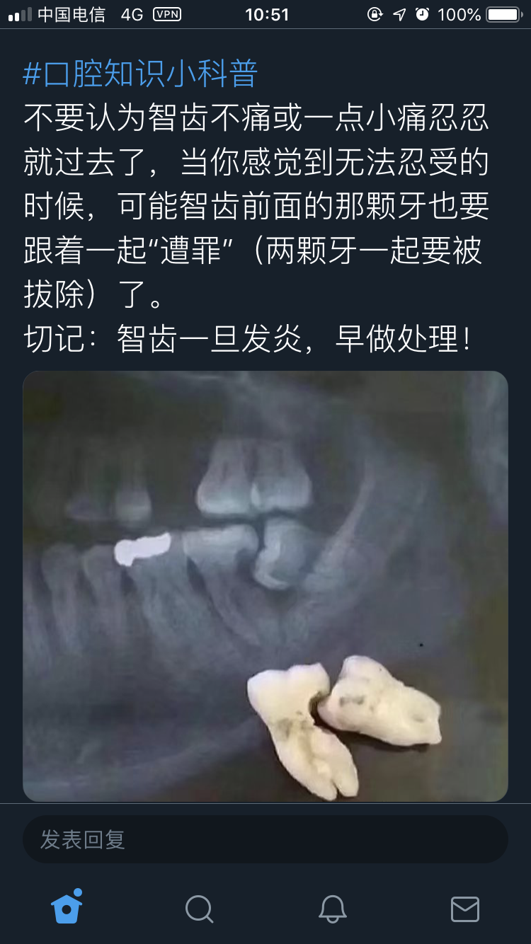 拔除右下智齿及术后记录